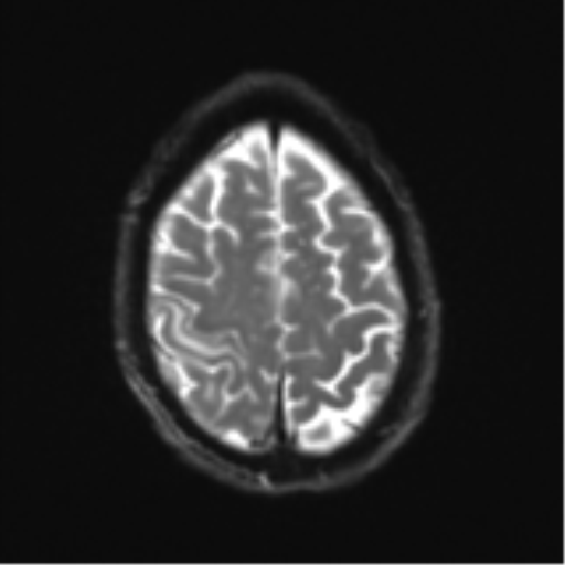 Cerebral metastasis - melanoma (Radiopaedia 54718-60954 Axial DWI 25).png