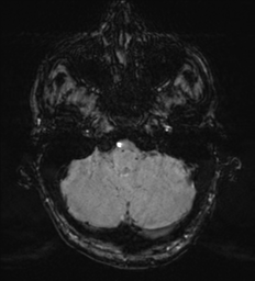 Cerebral metastasis - melanoma (Radiopaedia 54718-60954 Axial SWI 10).png
