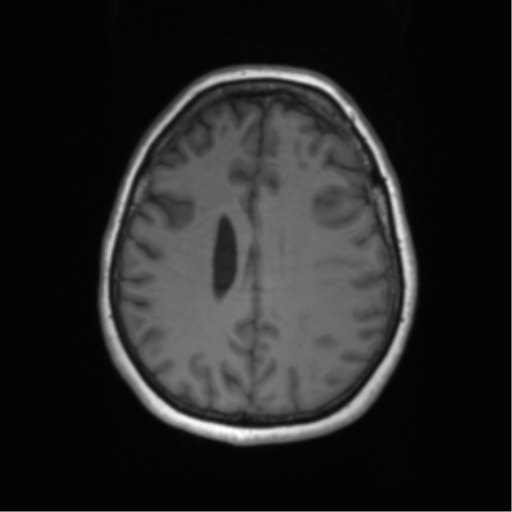 Cerebral metastasis mimicking glioblastoma (Radiopaedia 69155-78937 Axial T1 46).png