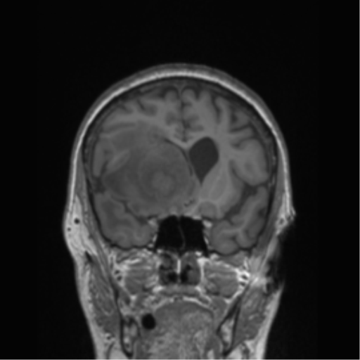Cerebral metastasis to basal ganglia (Radiopaedia 81568-95413 Coronal T1 40).png