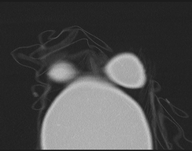 Cerebral metastasis to basal ganglia (Radiopaedia 81568-95414 Coronal lung window 4).png