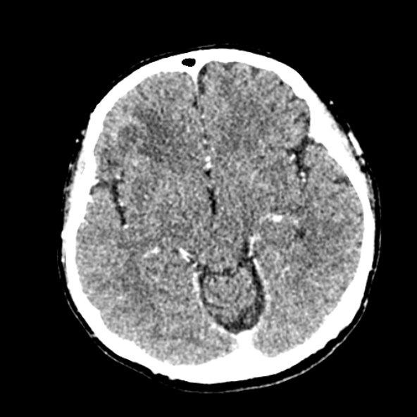 Cerebral ring enhancing lesions - cerebral metastases (Radiopaedia 44922-48818 B 125).jpg