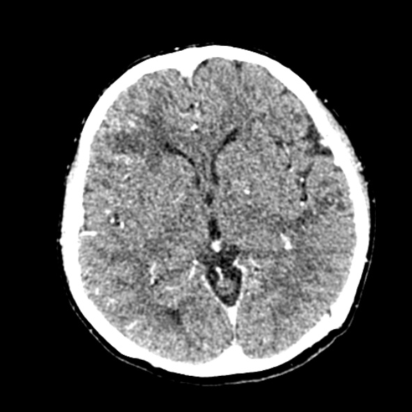 Cerebral ring enhancing lesions - cerebral metastases (Radiopaedia 44922-48818 B 142).jpg