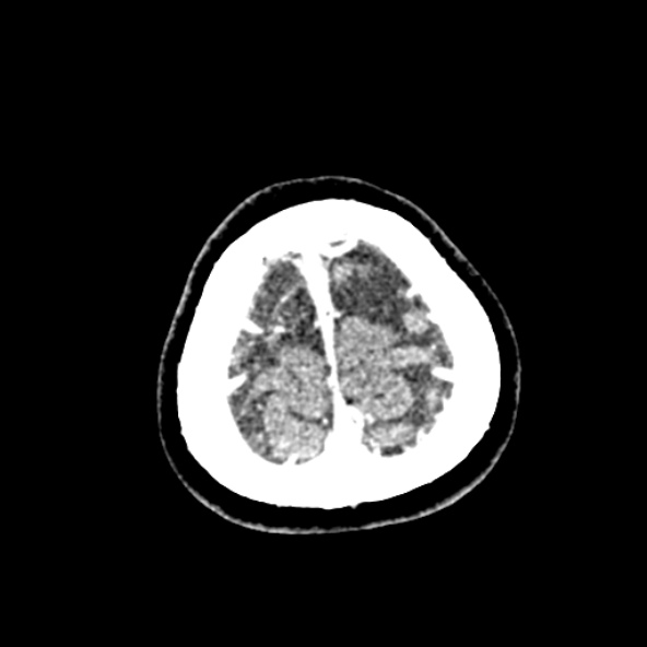 Cerebral ring enhancing lesions - cerebral metastases (Radiopaedia 44922-48818 B 265).jpg