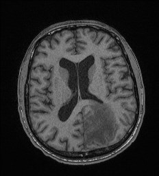 Cerebral toxoplasmosis (Radiopaedia 43956-47461 Axial T1 45).jpg