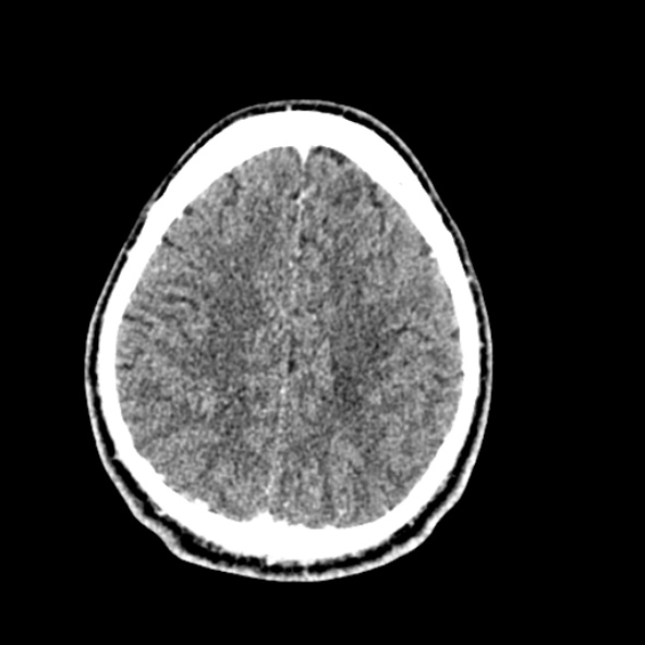 File:Cerebral toxoplasmosis (Radiopaedia 53993-60131 Axial C+ delayed 56).jpg