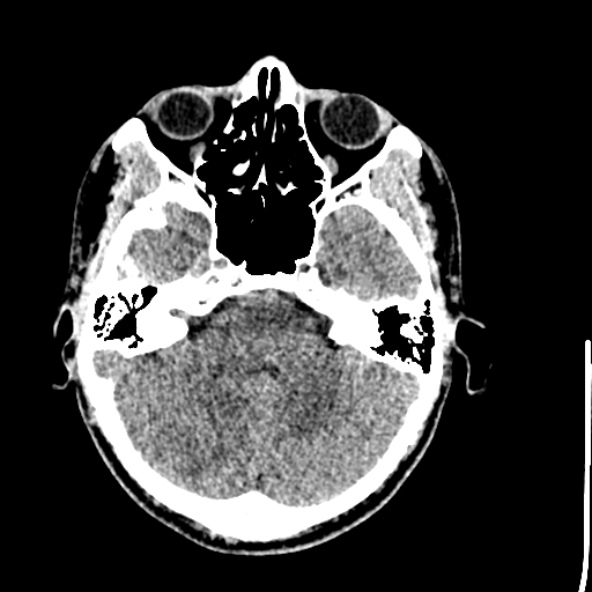 Cerebral toxoplasmosis (Radiopaedia 53993-60131 Axial non-contrast 22).jpg