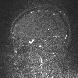 Cerebral tuberculosis with dural sinus invasion (Radiopaedia 60353-68090 Sagittal MRV 53).jpg