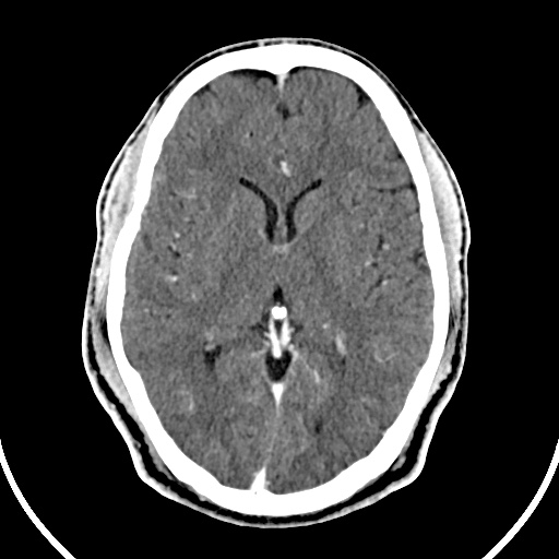 File:Cerebral venous angioma (Radiopaedia 69959-79977 B 46).jpg