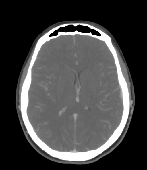 Cerebral venous hemorrhagic infarction (Radiopaedia 38461-40550 Axial MIP VENOGRAM 30).png