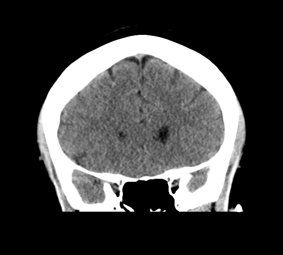 File:Cerebral venous infarct related to dural venous sinus thromboses (Radiopaedia 35292-36804 Coronal non-contrast 12).png