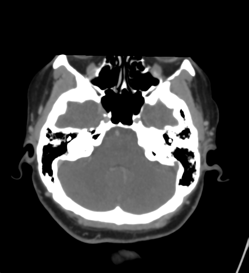 Cerebral venous infarction due to transverse sinus thrombosis (Radiopaedia 34688-36120 Axial CT venogram 14).png