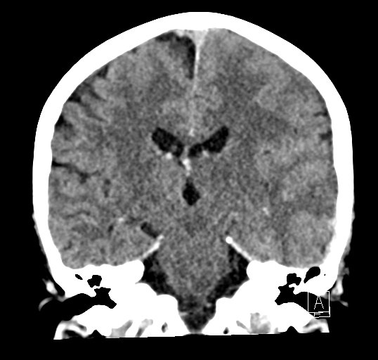 Cerebral venous infarction with hemorrhage (Radiopaedia 65343-74381 Coronal non-contrast 30).jpg