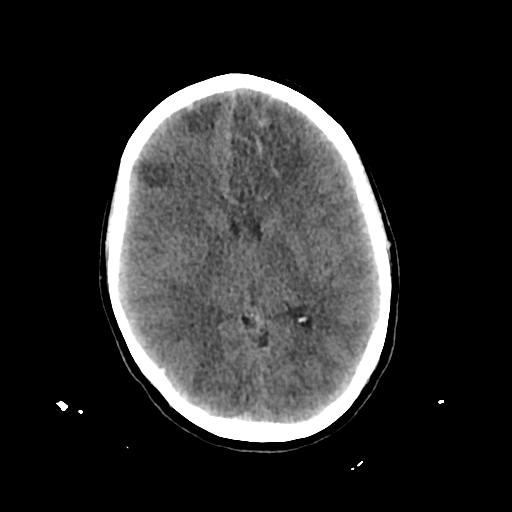 Cerebral venous throbmosis - hemorrhagic venous infarction (Radiopaedia 87318-103613 Axial non-contrast 87).jpg