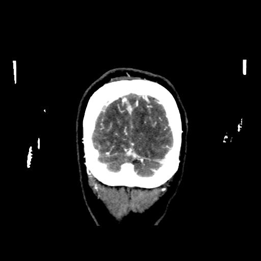 File:Cerebral venous throbmosis - hemorrhagic venous infarction (Radiopaedia 87318-103613 Coronal CT venogram 39).jpg
