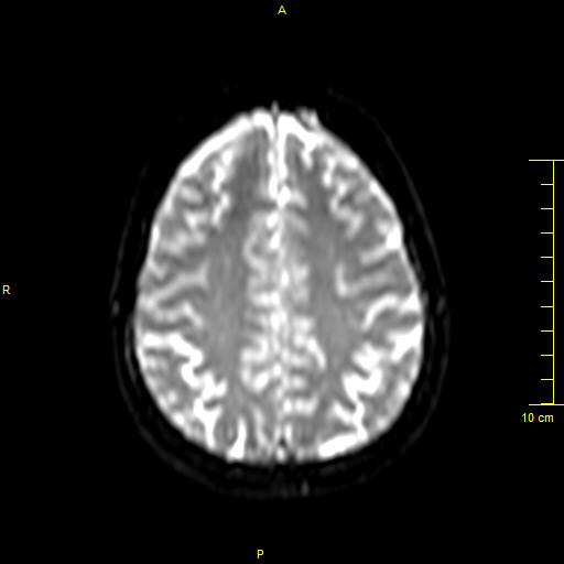 File:Cerebral venous thrombosis (Radiopaedia 23288-23351 Axial DWI 32).JPG
