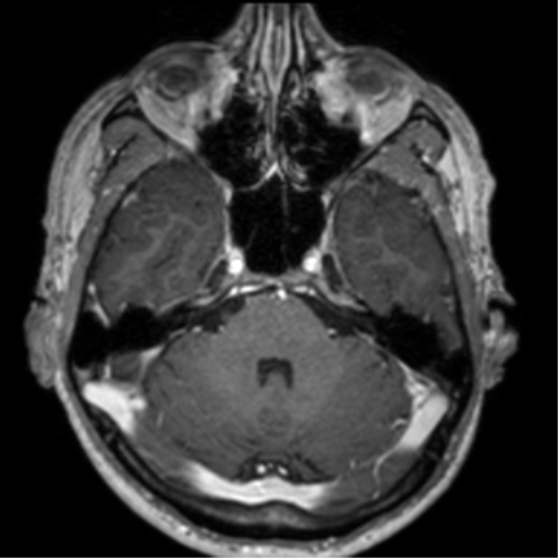 Cerebral venous thrombosis (Radiopaedia 38392-40469 Axial T1 C+ 24).png