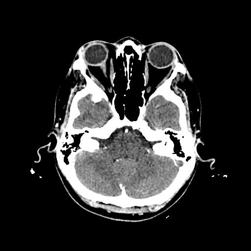 Cerebral venous thrombosis with venous hemorrhagic infarct (Radiopaedia 90354-107660 Axial with contrast 43).jpg