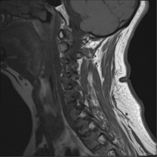 File:Cervical canal stenosis due to ossification of the posterior longitudinal ligament (Radiopaedia 47260-51824 Sagittal T1 4).png