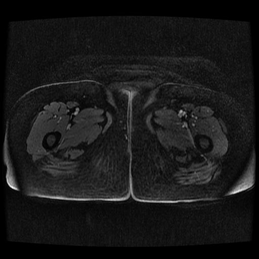 Cervical carcinoma (Radiopaedia 70924-81132 Axial T1 C+ fat sat 7).jpg