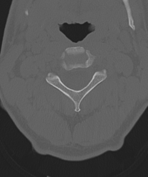 Cervical intercalary bone (Radiopaedia 35211-36748 Axial bone window 22).png
