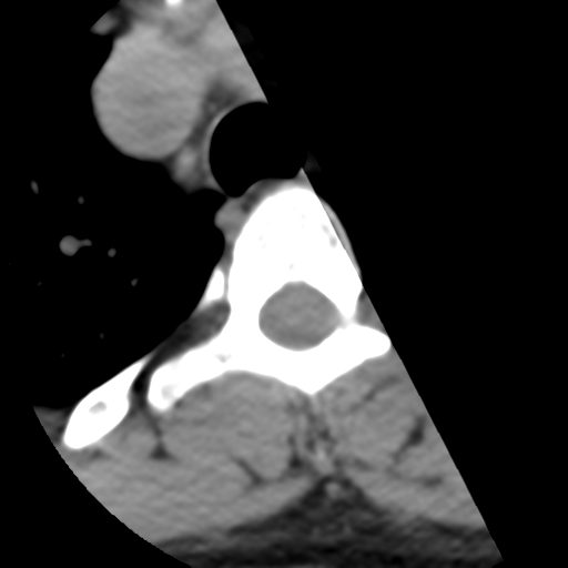 Cervical schwannoma (Radiopaedia 57979-64974 Axial non-contrast 75).png