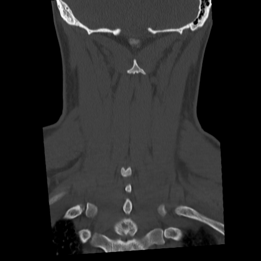 Cervical schwannoma (Radiopaedia 57979-64974 Coronal bone window 45).png