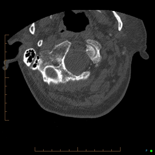 File:Cervical spine fracture - ankylosing spondylitis (Radiopaedia 76835-88706 Axial bone window 13).jpg