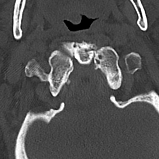 File:Cervical spine fracture - chalk stick (Radiopaedia 39116-41323 Axial bone window 16).png