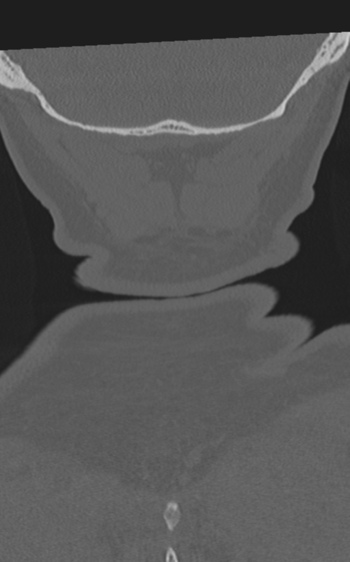 Cervical spine fractures with vertebral artery dissection (Radiopaedia 53296-59268 Coronal bone window 71).png