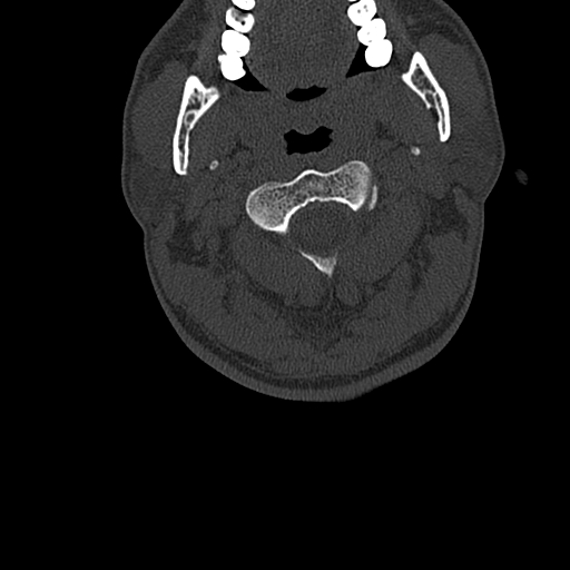 Cervical spine trauma with tear drop fracture and perched facet joint (Radiopaedia 53989-60127 Axial bone window 32).jpg