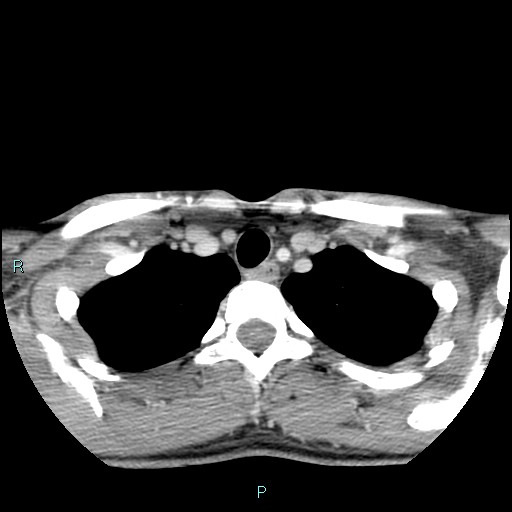 Cervical thymic cyst (Radiopaedia 88632-105335 C 25).jpg