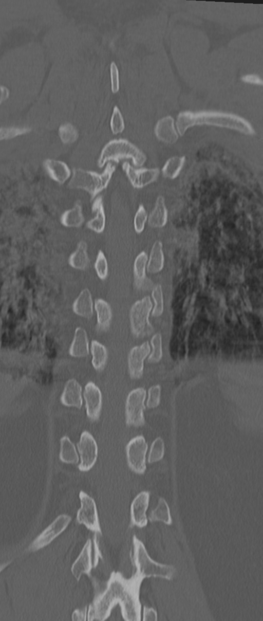 Chance fracture (Radiopaedia 33854-35020 Coronal bone window 62).png