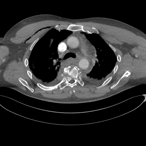 File:Chest multitrauma - aortic injury (Radiopaedia 34708-36147 A 110).png