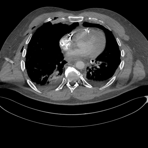 File:Chest multitrauma - aortic injury (Radiopaedia 34708-36147 A 185).png