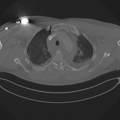 Chest multitrauma - aortic injury (Radiopaedia 34708-36147 Axial bone window 80).png
