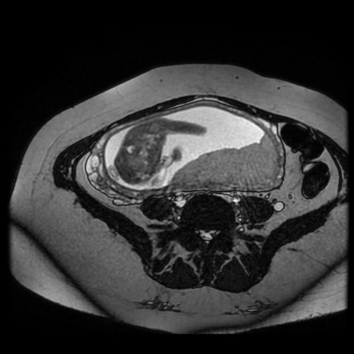 Chiari II malformation - fetal MRI (Radiopaedia 68099-77581 Axial Fiesta 26).jpg