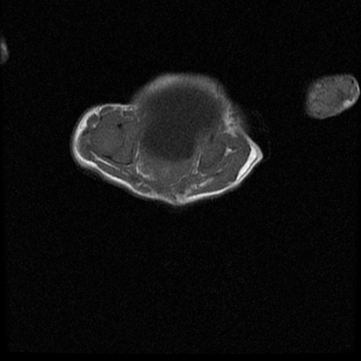 File:Chiari II malformation with spinal meningomyelocele (Radiopaedia 23550-23652 Axial T1 18).jpg