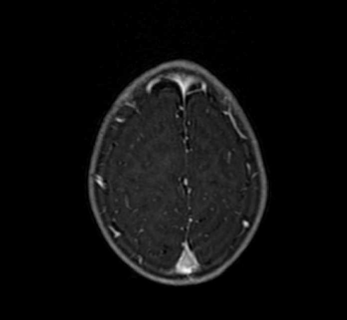 Chiasmatic-hypothalamic glioma (Radiopaedia 90079-107252 Axial T1 C+ 79).jpg