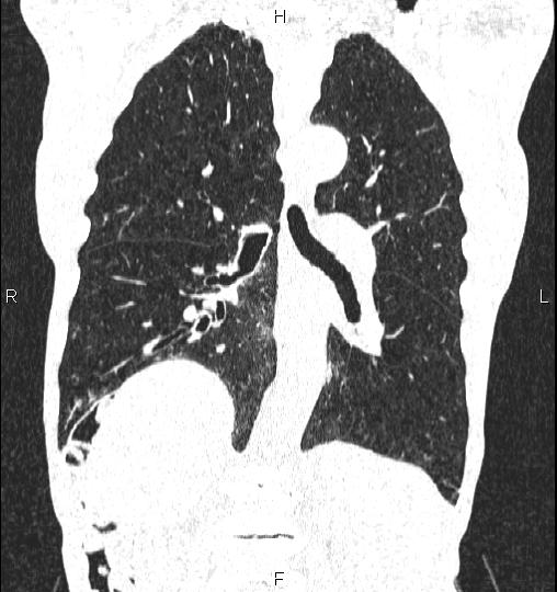 Chilaiditi sign (Radiopaedia 88839-105611 Coronal lung window 39).jpg