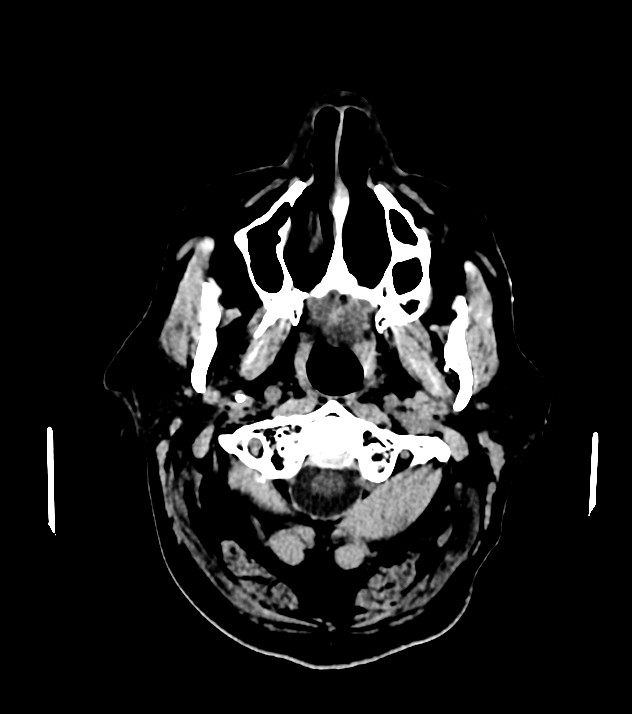 Cholangiocarcinoma with cerebral metastases (Radiopaedia 83519-98628 Axial non-contrast 5).jpg