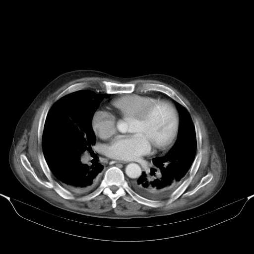 File:Cholangitis and abscess formation in a patient with cholangiocarcinoma (Radiopaedia 21194-21100 A 3).jpg