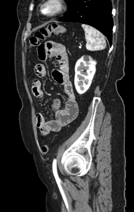 Cholecystoduodenal fistula due to calculous cholecystitis with gallstone migration (Radiopaedia 86875-103077 C 15).jpg