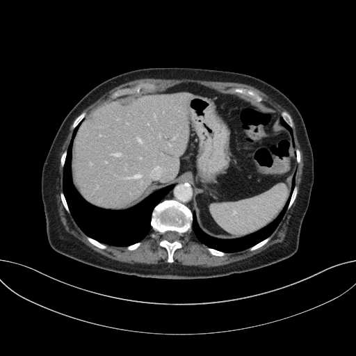 Cholecystoduodenal fistula due to calculous cholecystitis with gallstone migration (Radiopaedia 86875-103077 D 21).jpg