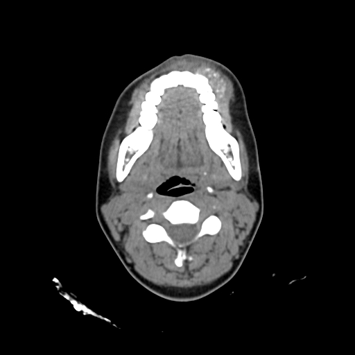 File:Chondroblastic osteosarcoma (Radiopaedia 67363-76741 Axial non-contrast 14).jpg