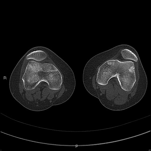 Chondroblastoma (Radiopaedia 62721-71030 Axial bone window 6).jpg