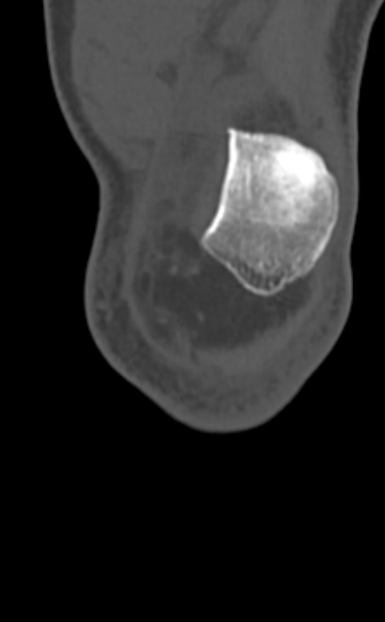Chondrocalcinosis (Radiopaedia 82862-97173 Coronal bone window 14).jpg