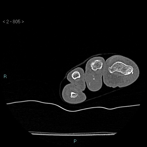 Chondrosarcoma - phalanx (Radiopaedia 69047-78812 Axial bone window 59).jpg