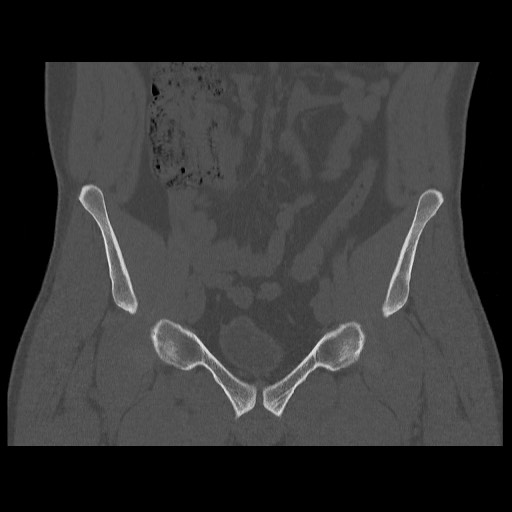 Chondrosarcoma of iliac wing (Radiopaedia 63861-72599 Coronal bone window 41).jpg