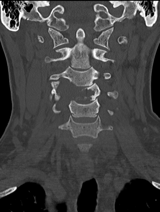 Chordoma (C4 vertebra) (Radiopaedia 47561-52188 Coronal bone window 19).png